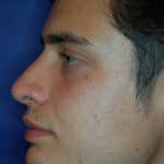 Patientenbegleitung Nasenkorrektur / 3 Monate nach der Operation