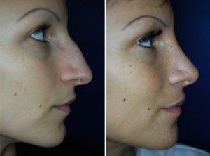 Nasenkorrektur Vorher - Nachher 4 Monate nach Höckerabtragung