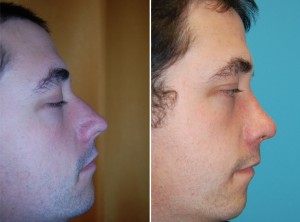 Nasenkorrektur Vorher - Nachher nach ca. 8 Wochen offener Nasenkorrektur