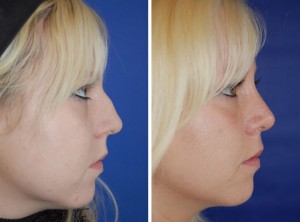 Nasenkorrektur Vorher - Nachher / Nach 4 Monaten