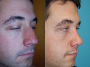 Nasenkorrektur Vorher - Nachher nach ca. 8 Wochen offener Nasenkorrektur