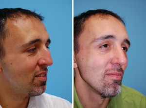 Nasenkorrektur Vorher - Nachher nach ca. 6 Wochen