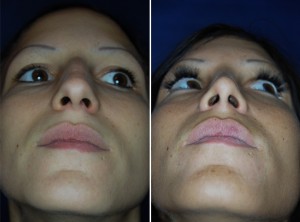 Nasenkorrektur Vorher - Nachher 4 Monate nach Höckerabtragung