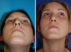 Nasenkorrektur Vorher - Nachher nach 5 Wochen