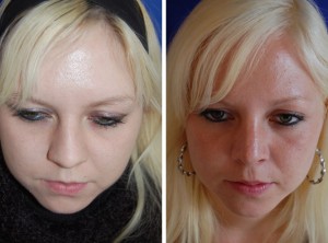 Nasenkorrektur Vorher - Nachher / Nach 4 Monaten