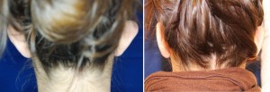 Ohrenkorrektur Vorher - Nachher nach 2 Monaten / Rückansicht