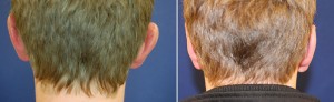 Ohrenkorrektur Vorher - Nachher / Rückansicht