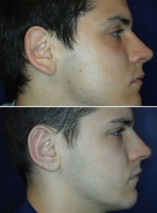 Ohrenkorrektur Vorher - Nachher / 2 Monate nach einer Ohranlegeplastik