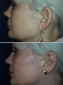 Ohrenkorrektur Vorher - Nachher / 3 Monate nach Ohranlegplastik