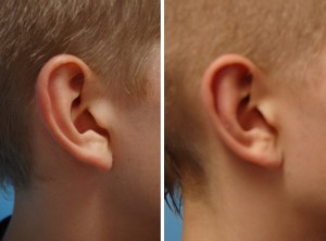 Ohrenkorrektur Vorher - Nachher / Mit zusätzlicher Verkleinerung des Ohrgrübchens