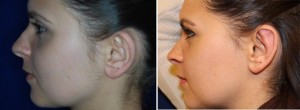 Ohrenkorrektur Vorher - Nachher nach 2 Monaten / Seitenansicht