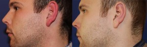 Ohrenkorrektur Vorher - Nachher / Seitenansicht